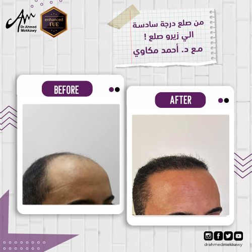 شروط زراعة الشعر